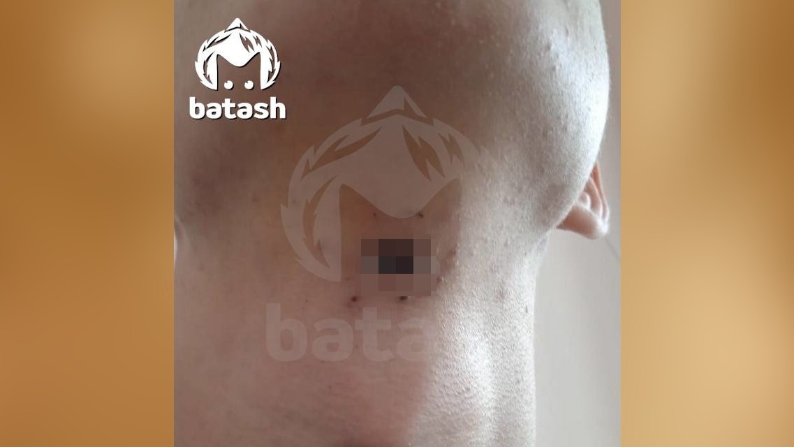Подросток из Башкирии два дня проходил с пулей в голове, скрывая факт от родителей